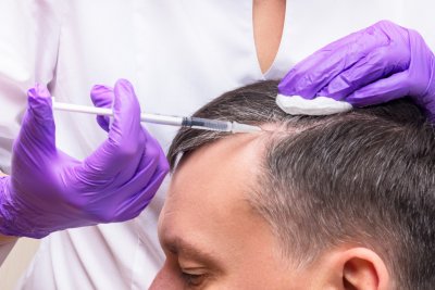 Haarsparende haartransplantatie, dit moet u weten!